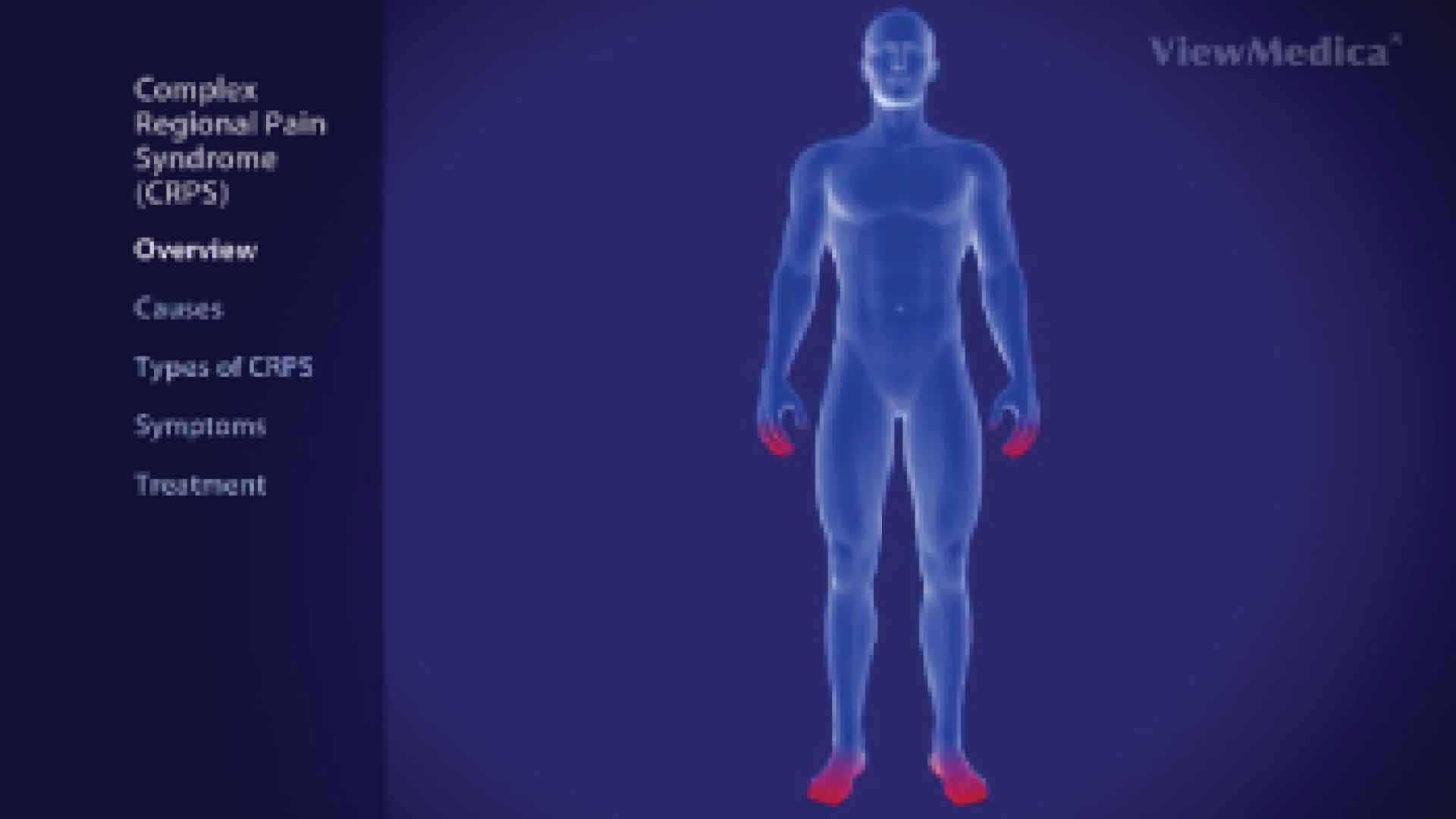 Complex regional pain syndrome