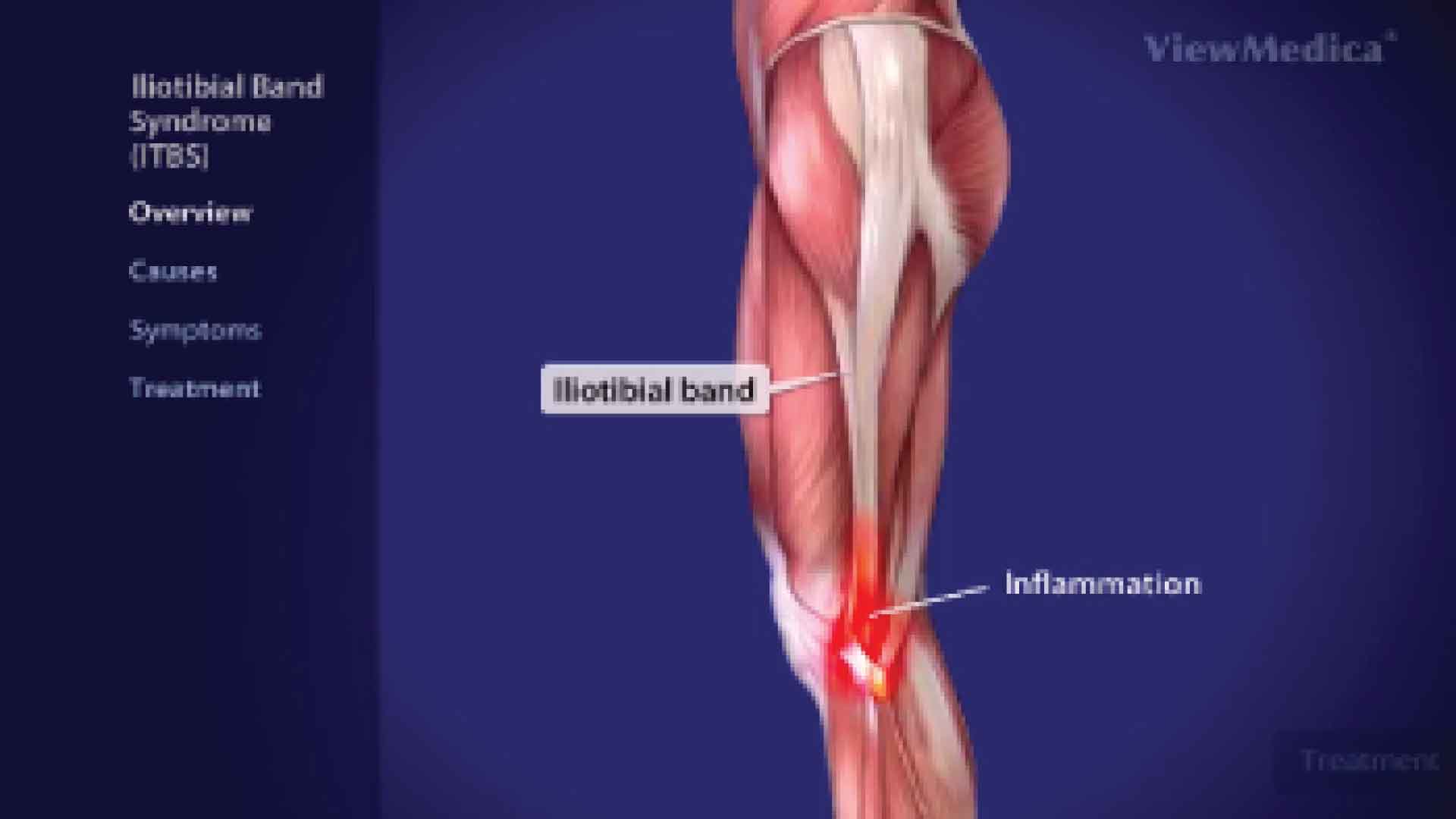 Illiotibial band syndrome