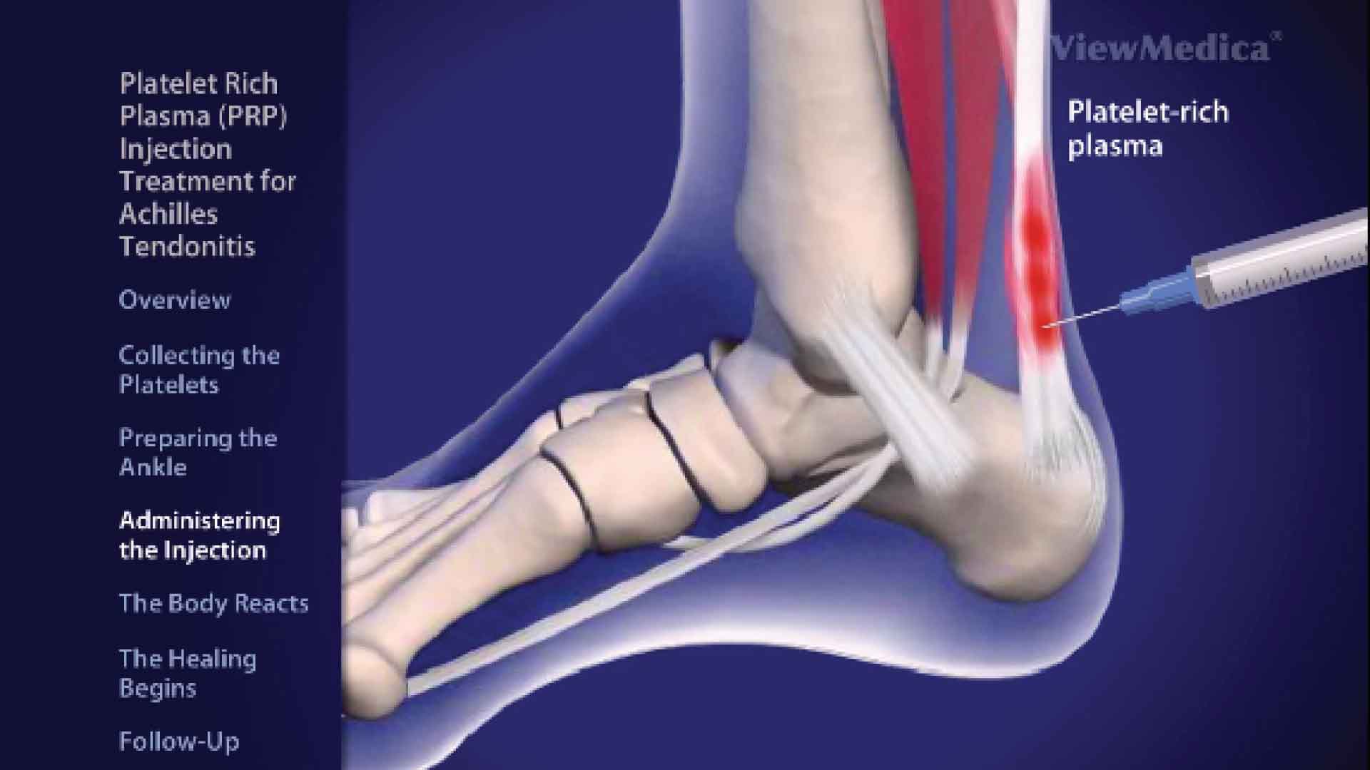 Plasma rich protein injections