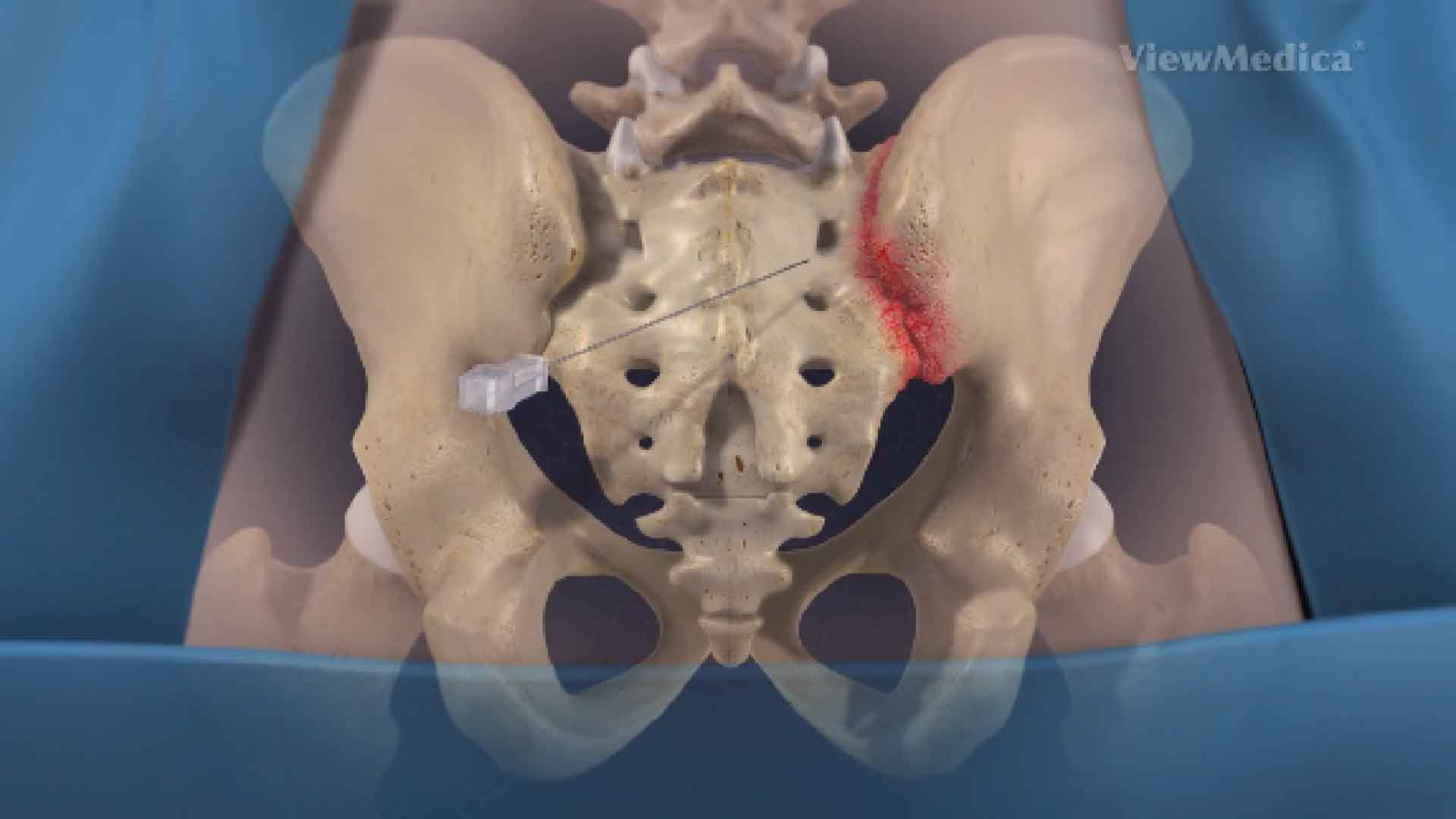 Sacroiliac joint treatment