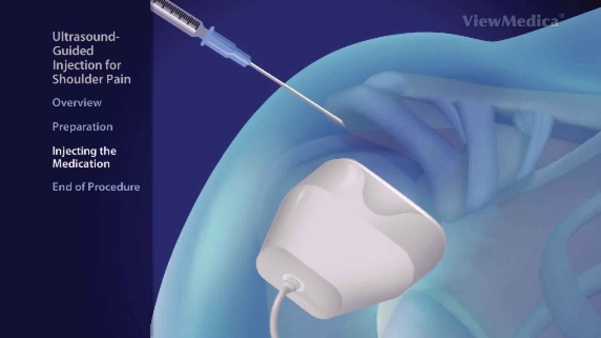 Ultrasound guided blocks