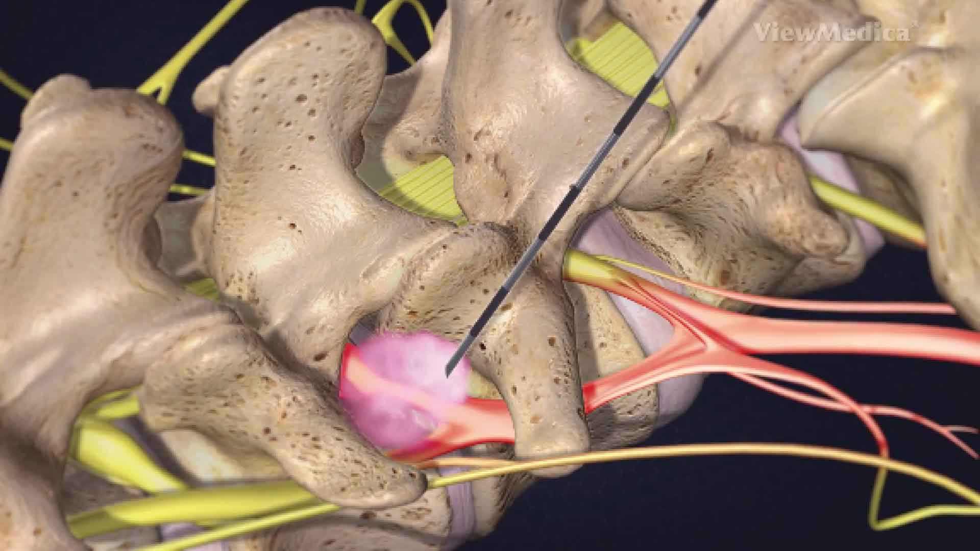 Transforaminal epidural