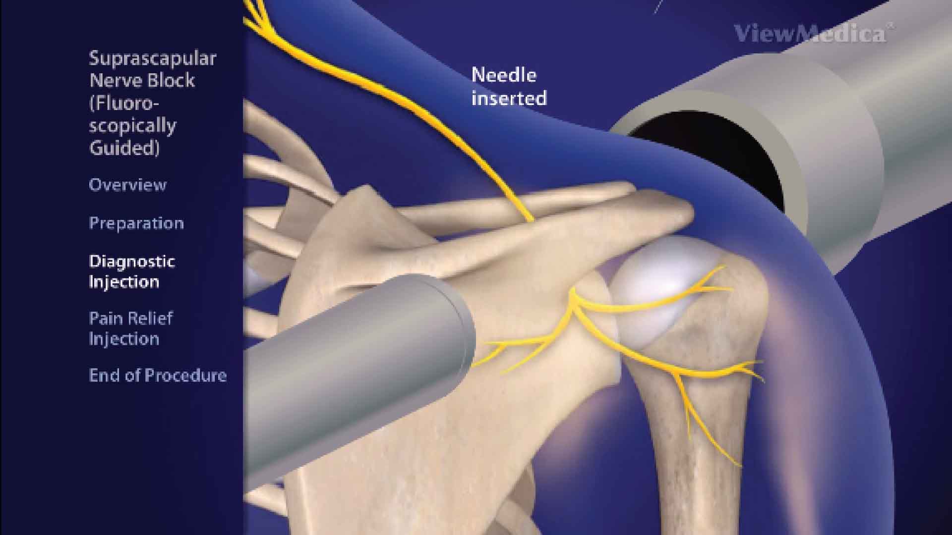 Suprascapular nerve treatment